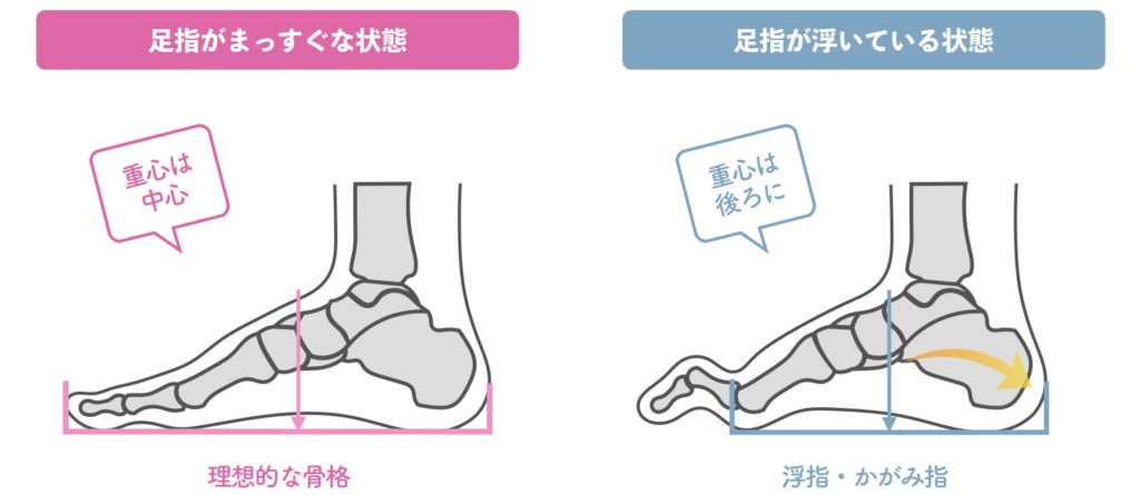 かがみ指 ハンマートゥ の症状と治療方法 足指研究の第一人者 湯浅慶朗の公式サイト