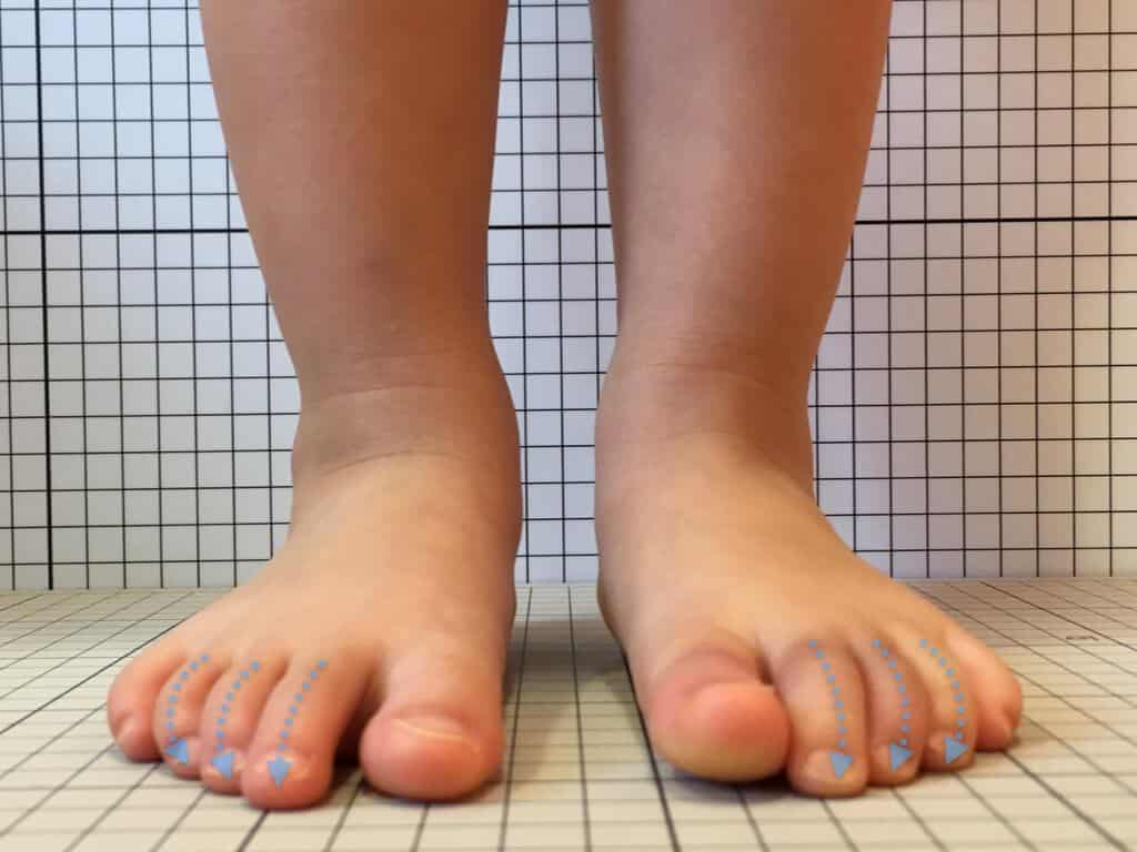 かがみ指 ハンマートゥ の症状と治療方法 足指研究の第一人者 湯浅慶朗の公式サイト