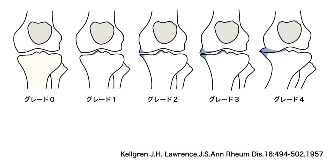 肥満と変形性膝関節症は無関係！？体重を落とさず膝の変形を改善する方法 | ひろのば体操 オフィシャルサイト